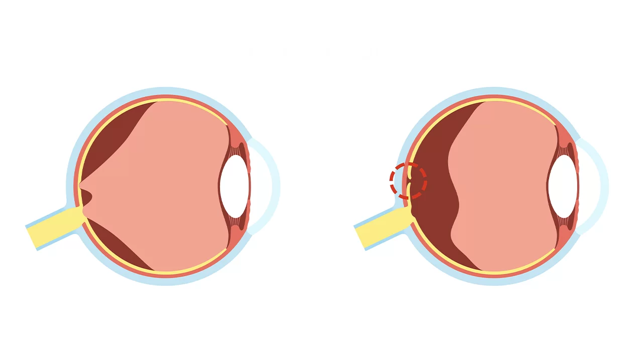 Macular Hole